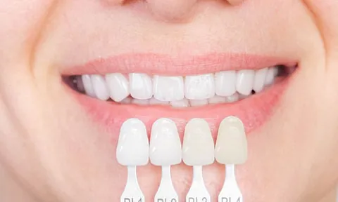 Lächelnder Mund mit weißen Zähnen und vier Zahnfarbtabellen zum Vergleich von Veneers