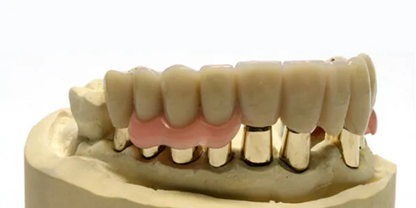 Zahnprothese mit goldfarbenen Zahnkronen auf einem Zahnstumpfmodell