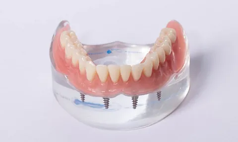 Unterkieferprothese auf transparentem Modell mit vier Implantatschrauben zur Befestigung